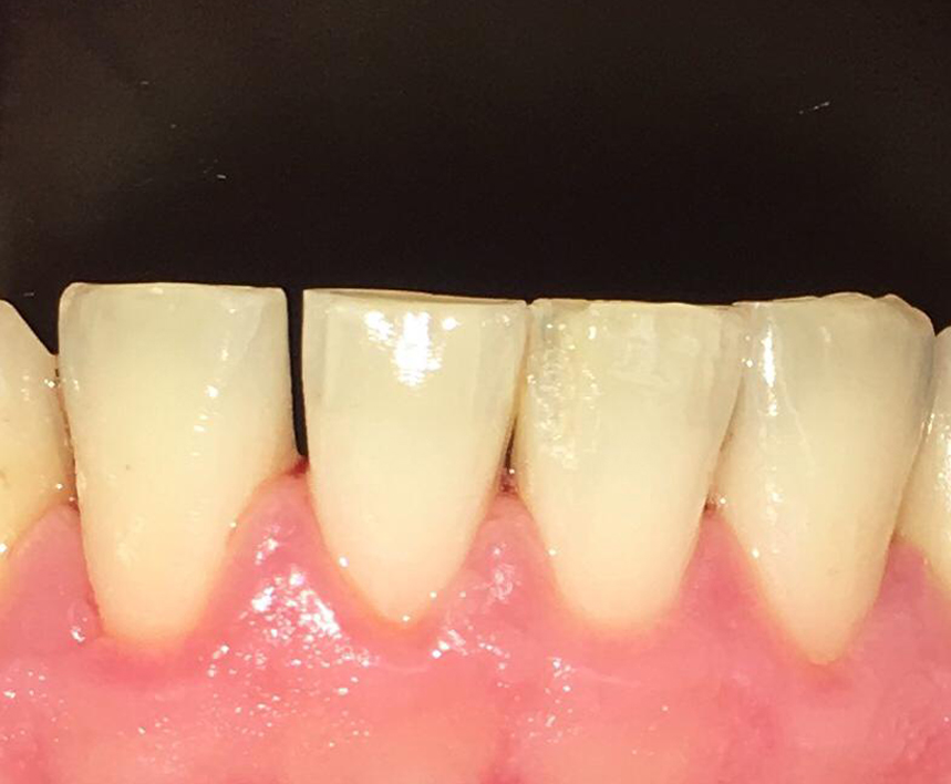 before and after tooth cleaning in  cookstown