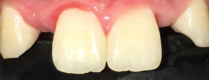 dental bonding northern ireland