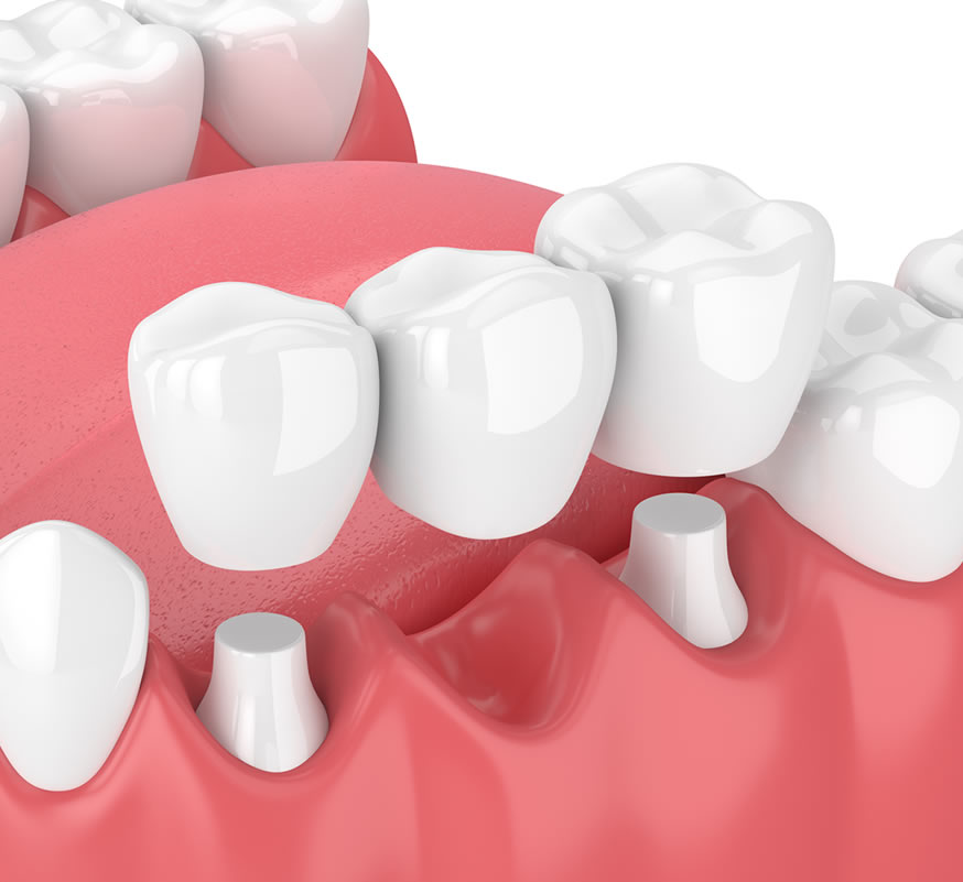 graphic of dental bridge