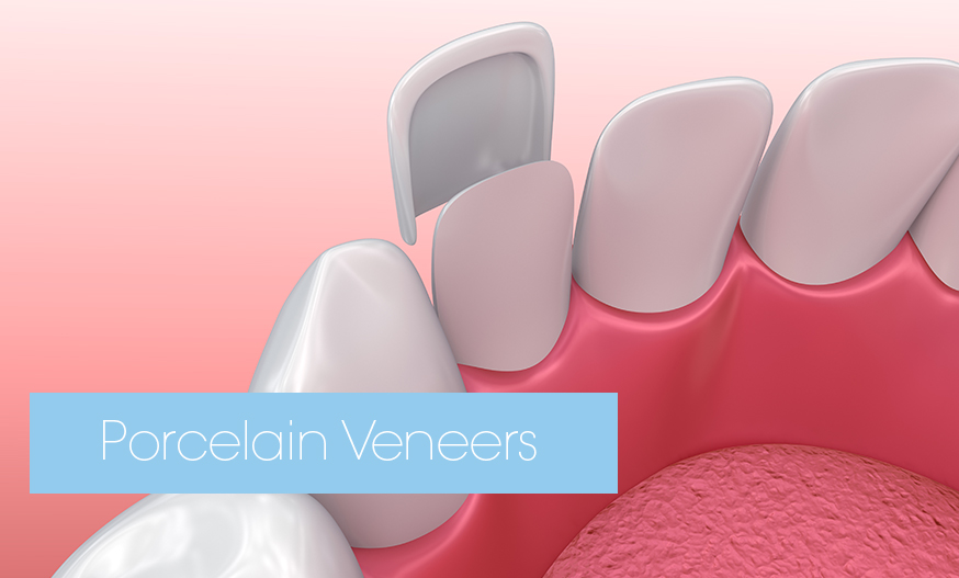 porcelain veneer being fitting to a tooth